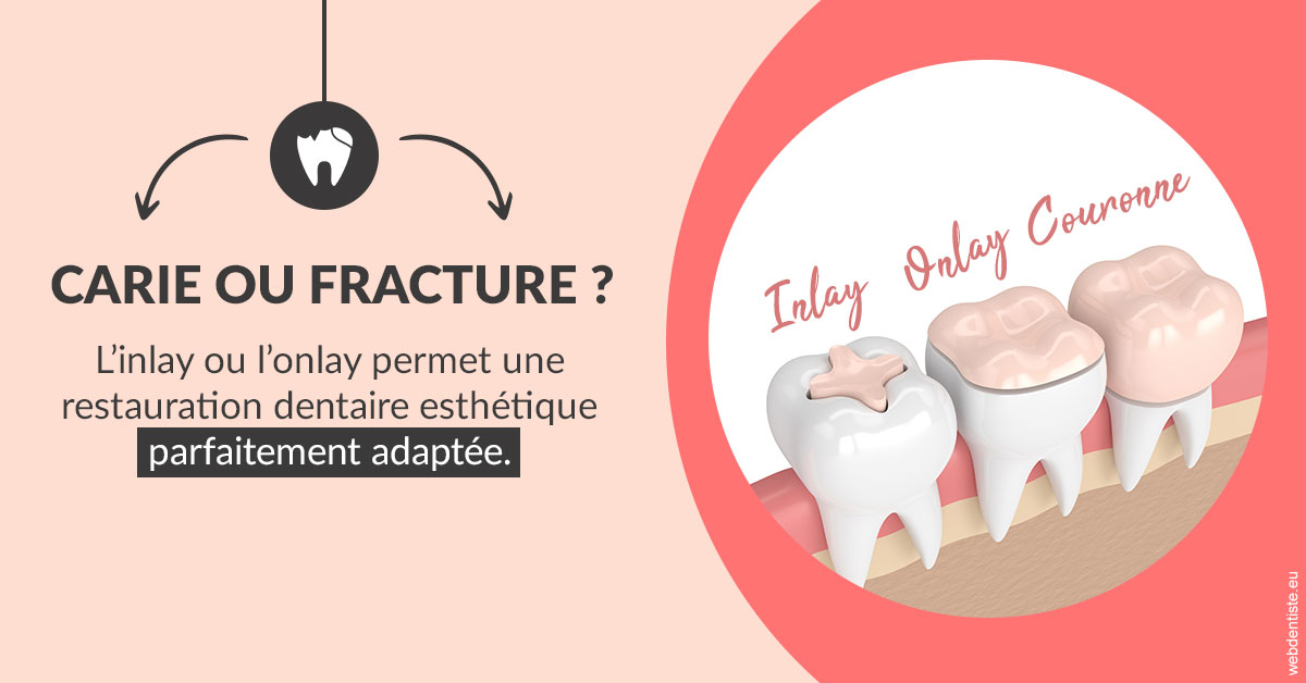 https://www.orthodontie-nappee.fr/T2 2023 - Carie ou fracture 2