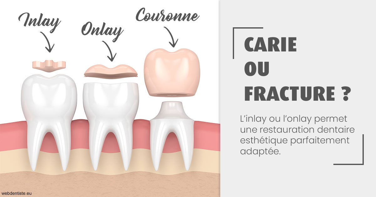 https://www.orthodontie-nappee.fr/T2 2023 - Carie ou fracture 1