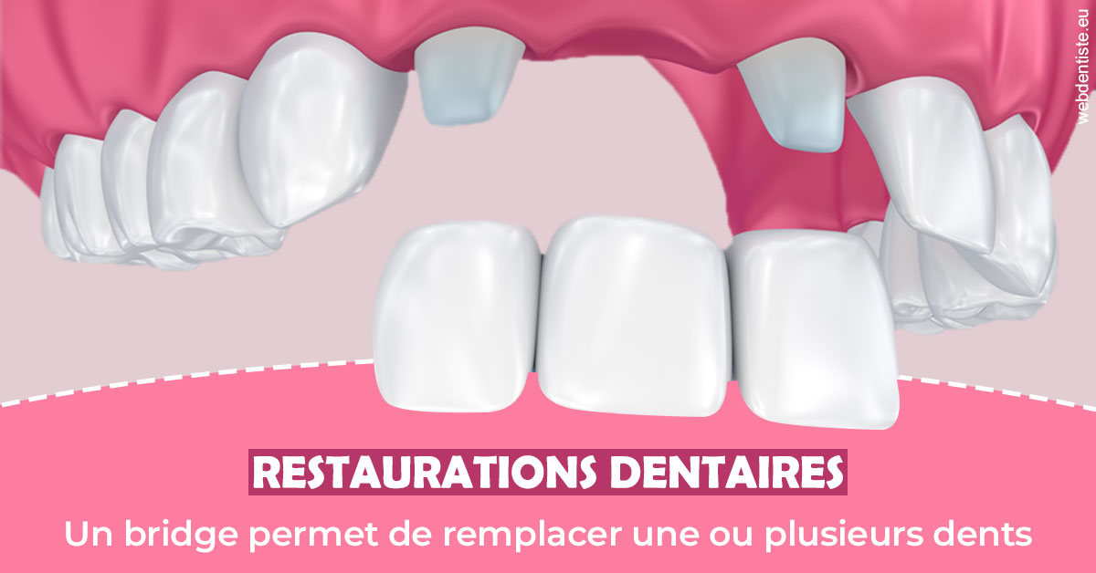 https://www.orthodontie-nappee.fr/Bridge remplacer dents 2