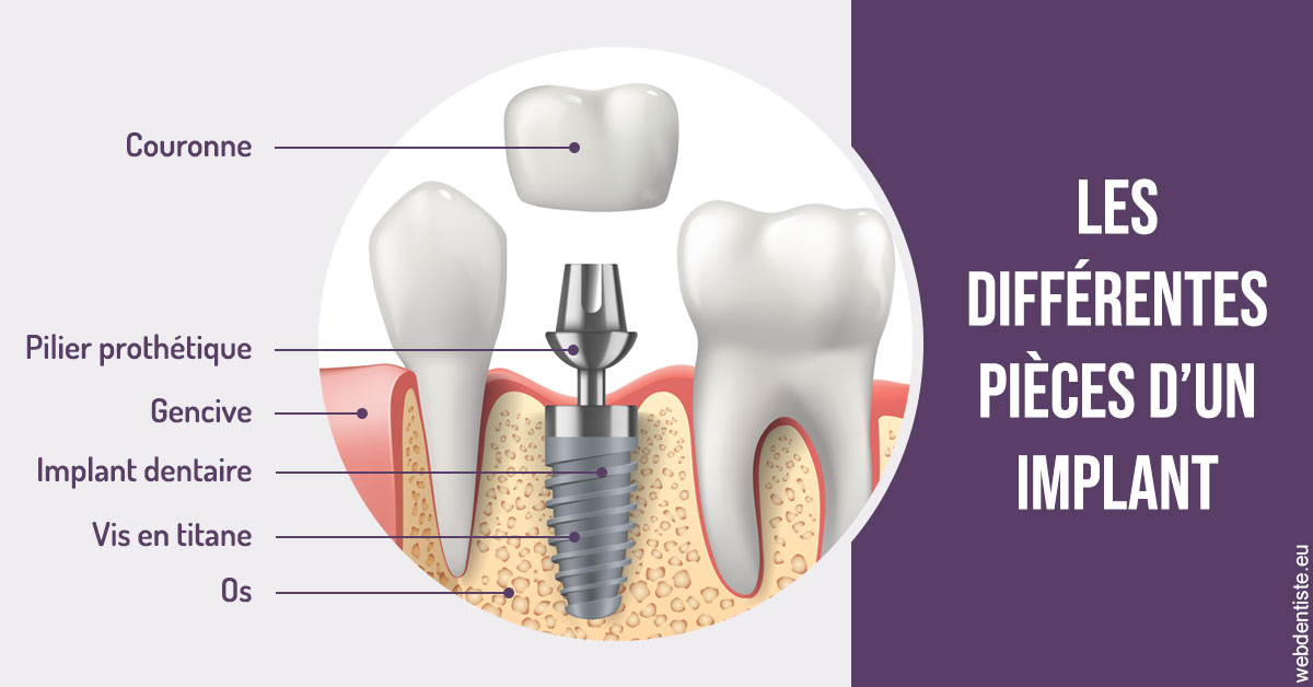 https://www.orthodontie-nappee.fr/Les différentes pièces d’un implant 2