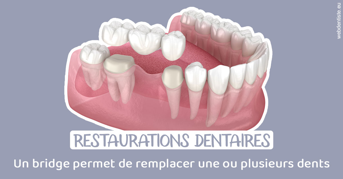 https://www.orthodontie-nappee.fr/Bridge remplacer dents 1