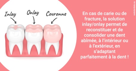 https://www.orthodontie-nappee.fr/L'INLAY ou l'ONLAY 2