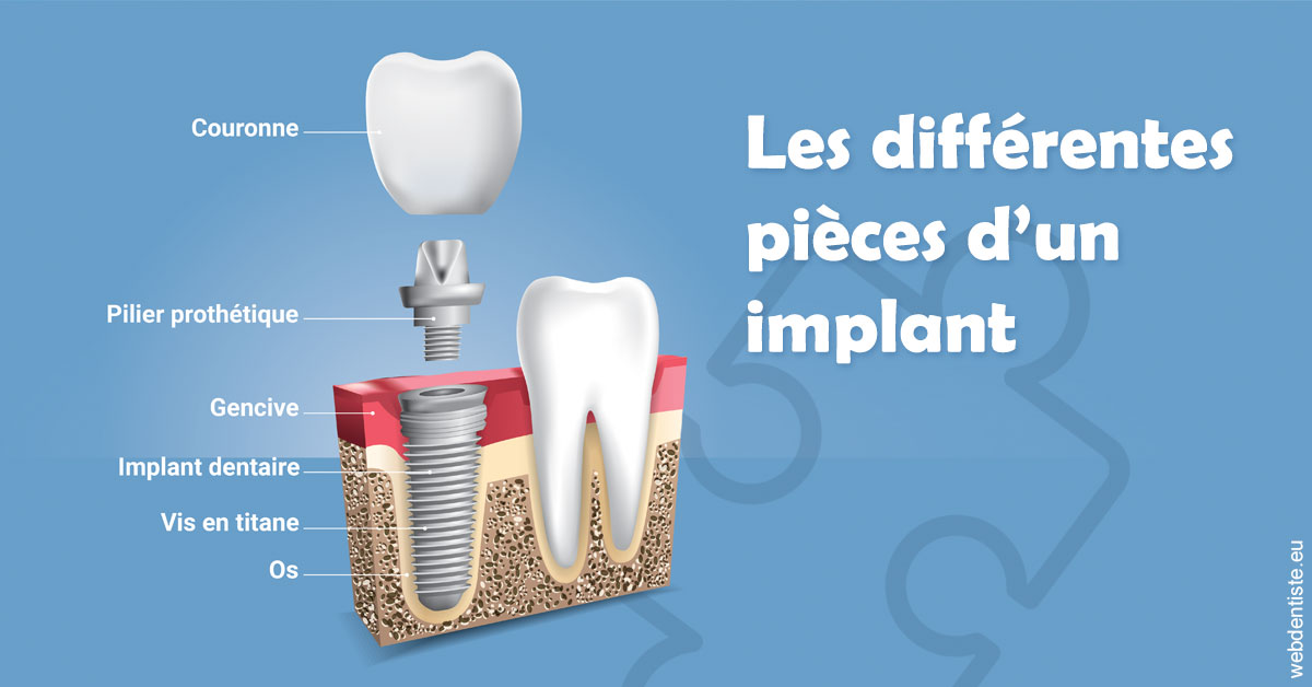 https://www.orthodontie-nappee.fr/Les différentes pièces d’un implant 1
