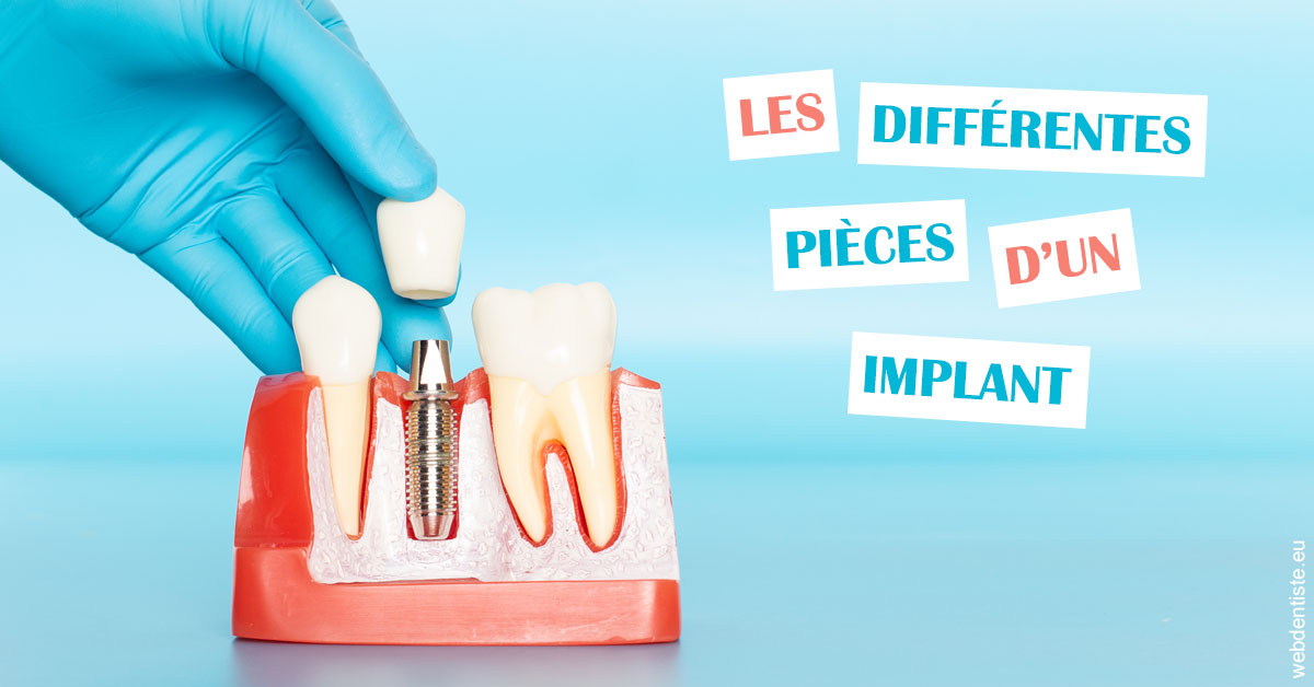 https://www.orthodontie-nappee.fr/Les différentes pièces d’un implant 2