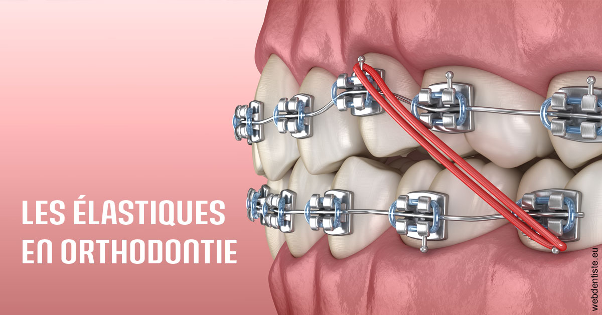 https://www.orthodontie-nappee.fr/Elastiques orthodontie 2